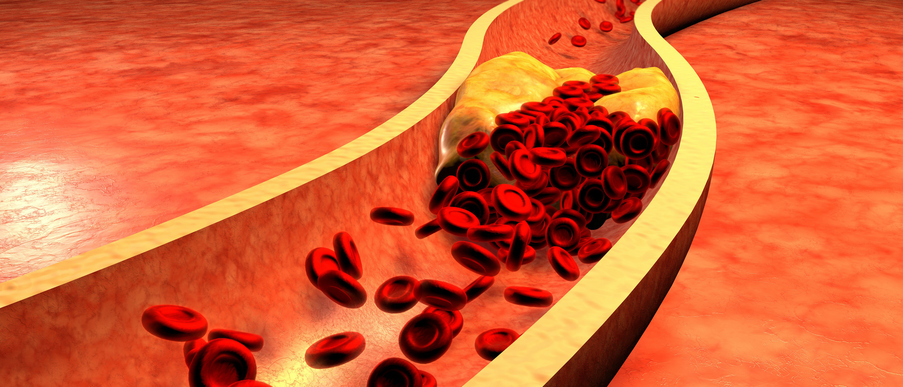 Coronary artery disease in elder...