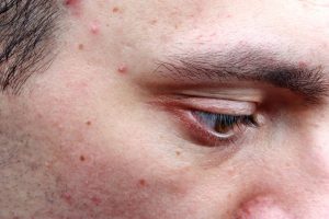 History of acne may signal slower skin aging