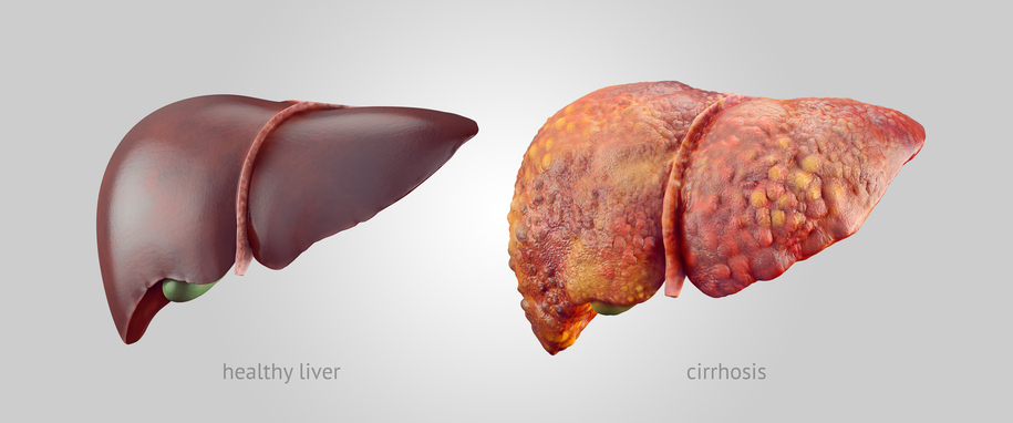Liver cirrhosis: Causes, symptom...