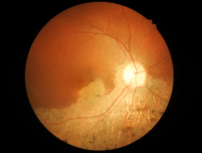 Macular hole causes, symptoms, t...