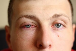 natural home remedies for conjuctivitis
