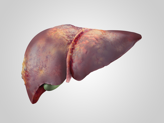 Non-alcoholic steatohepatitis (N...