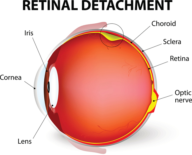 Detached retina causes, symptoms...