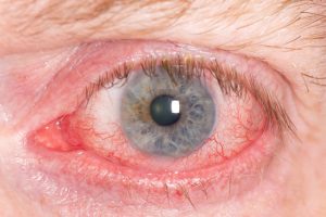 scleritis inflammation of the white of the eye