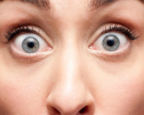 What causes bulging eyes or protruding eyeballs?