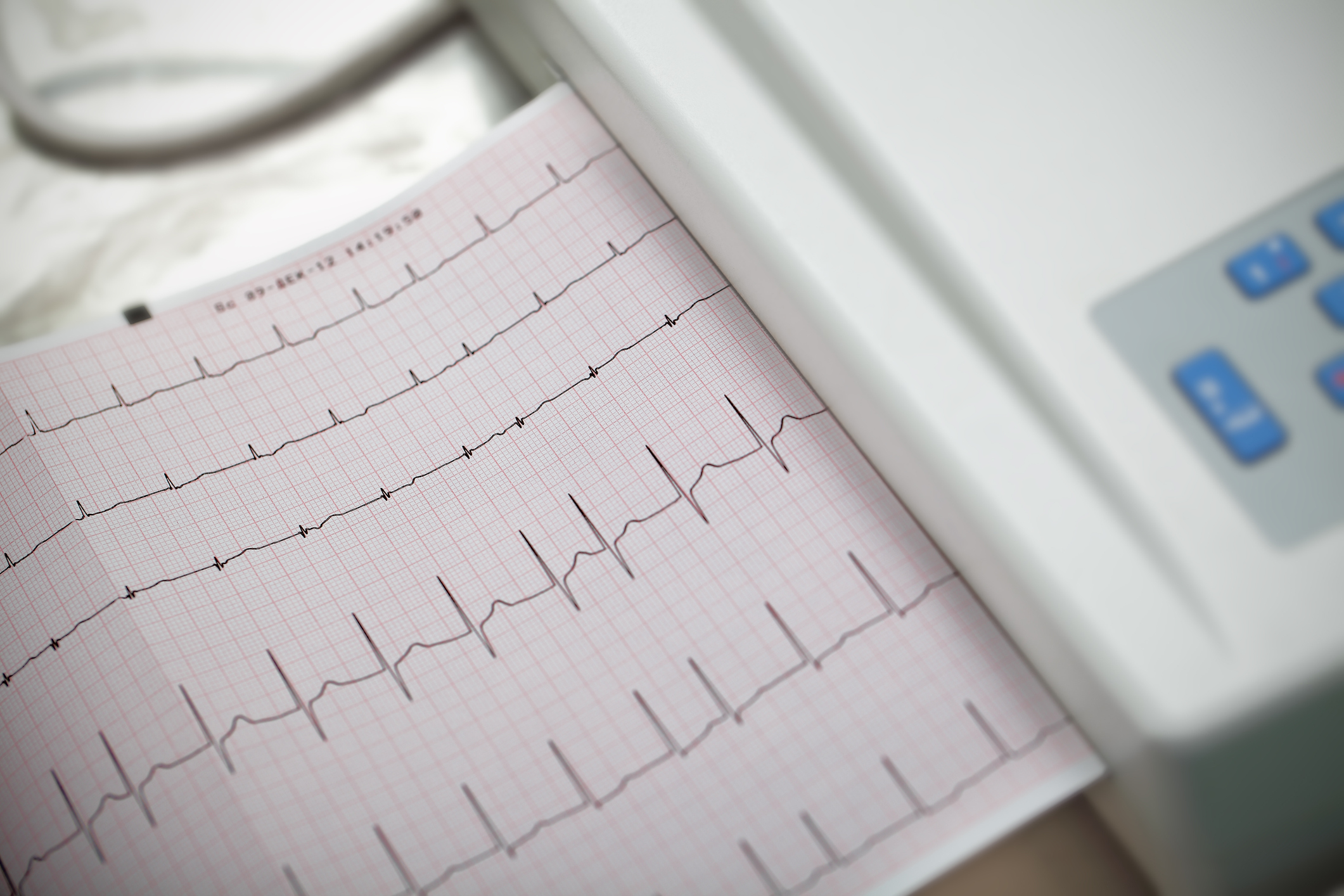 Atrial fibrillation (irregular h...