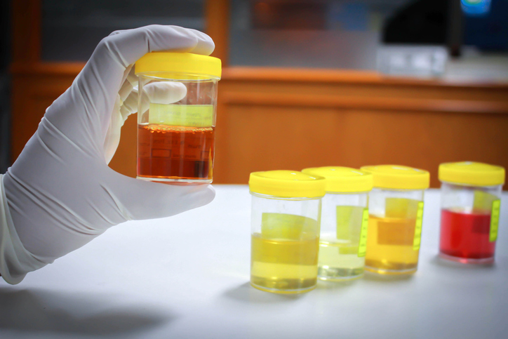 What the color of your urine means