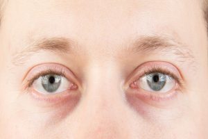 Corneal ulcer: Diagnosis, treatment, and prevention