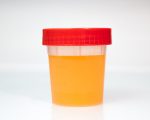Dark urine: Causes, treatments, and prevention
