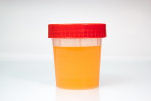 Dark urine: Causes, treatments, and prevention