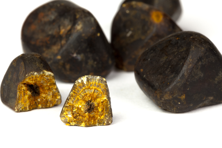 Gallstone complications: Cholecy...