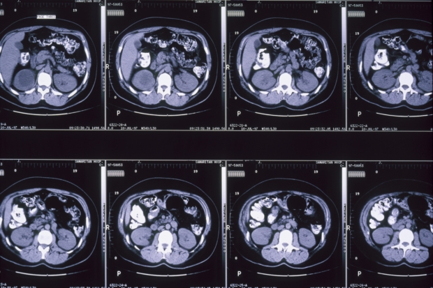 Brain scans help to diagnose dem...