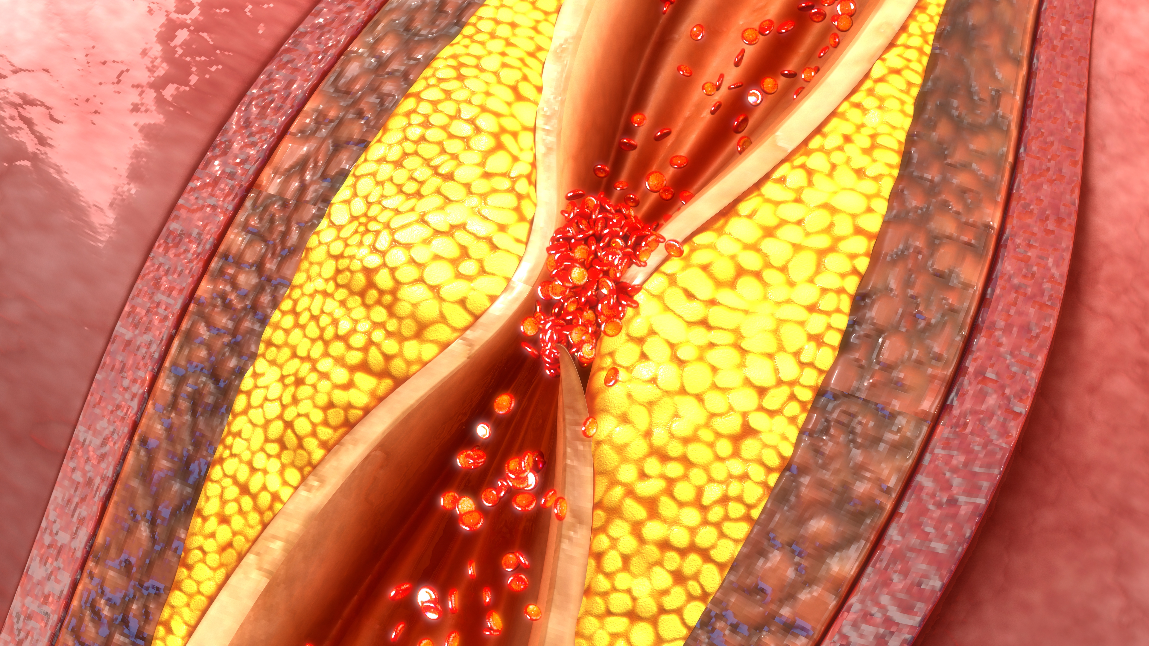 Clogged arteries: Signs and symp...