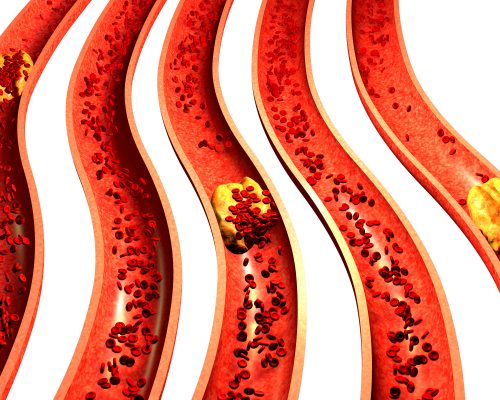 Coronary Artery Disease Incidence Declined By Nearly 20 Percent In The U S New Study