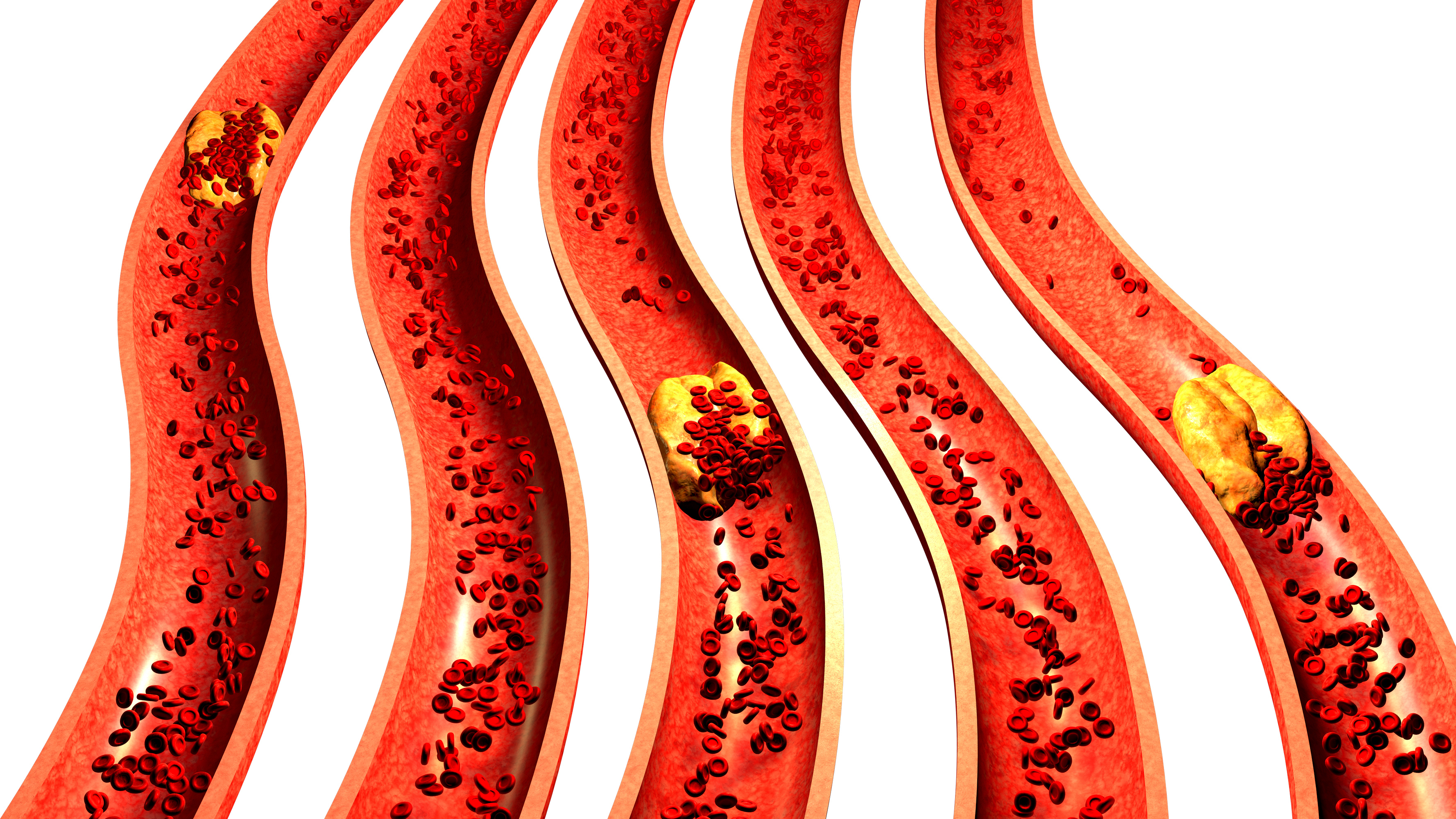 Coronary artery disease incidenc...