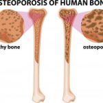 Diabetes and bone loss: Strategies to manage bone health with diabetes