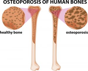 bone loss and diabetes