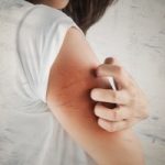 eczema-skin-surface