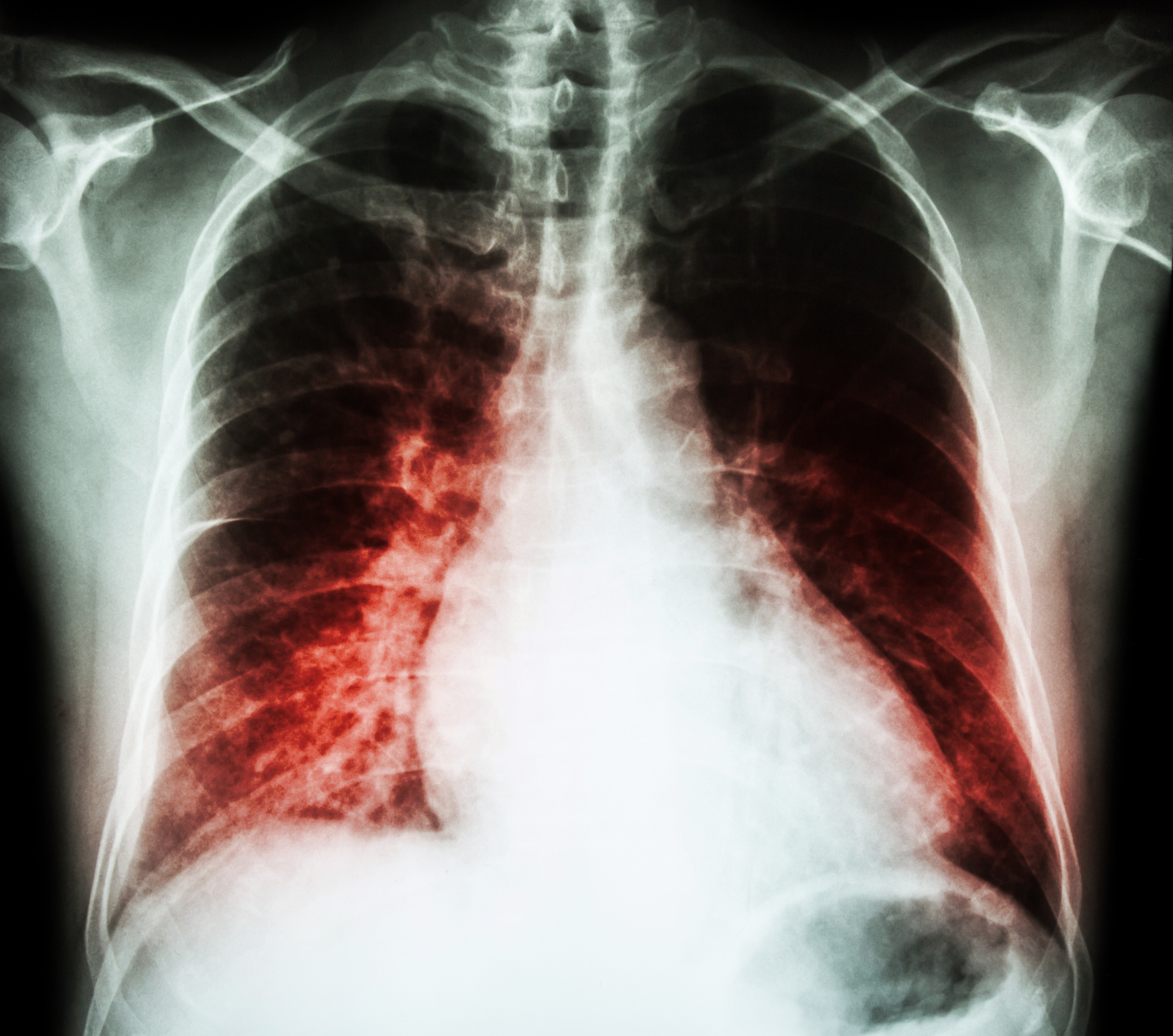 Enlarged heart (cardiomegaly): C...