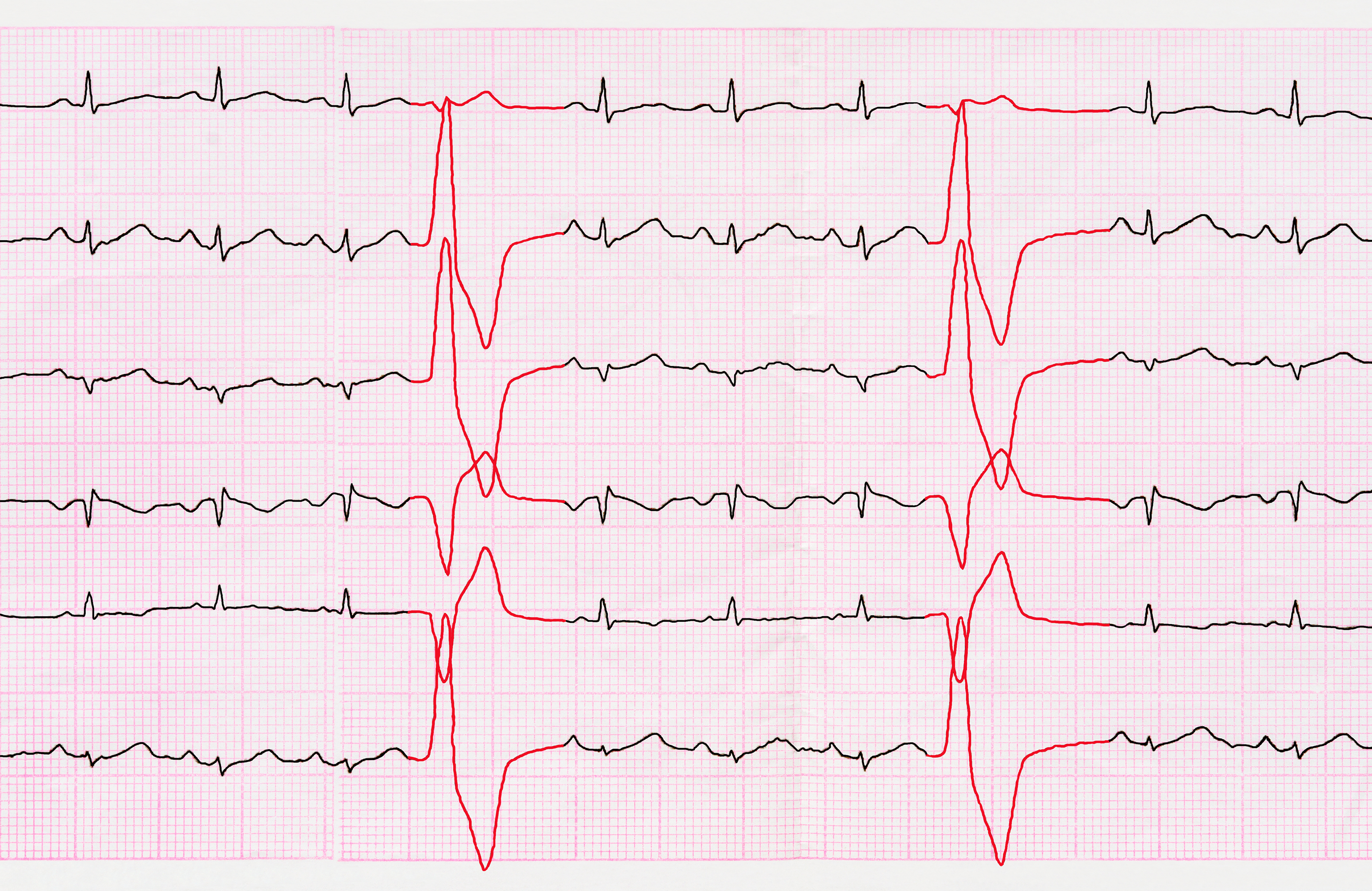 Heart arrhythmia: Diagnosis, tes...