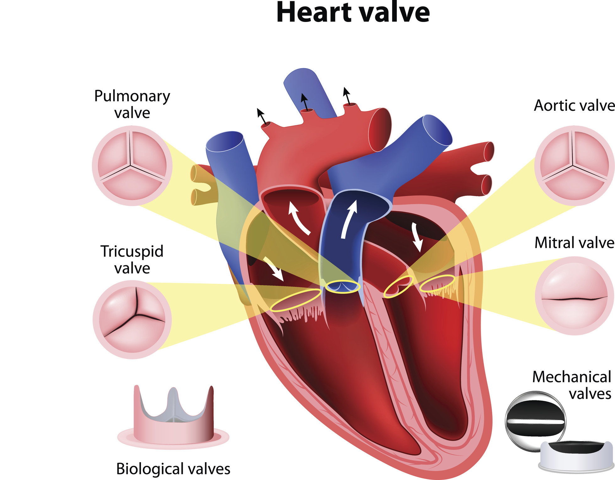 Heart valve disease: Causes, ris...