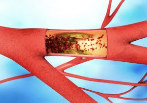peripheral artery disease risk increases with hypertension