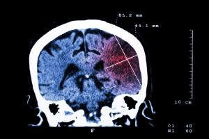 Ischemic stroke risk linked to traumatic brain injury (TBI), independent of other factors