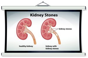 First case of kidney stones linked to higher risk of chronic kidney disease: Study