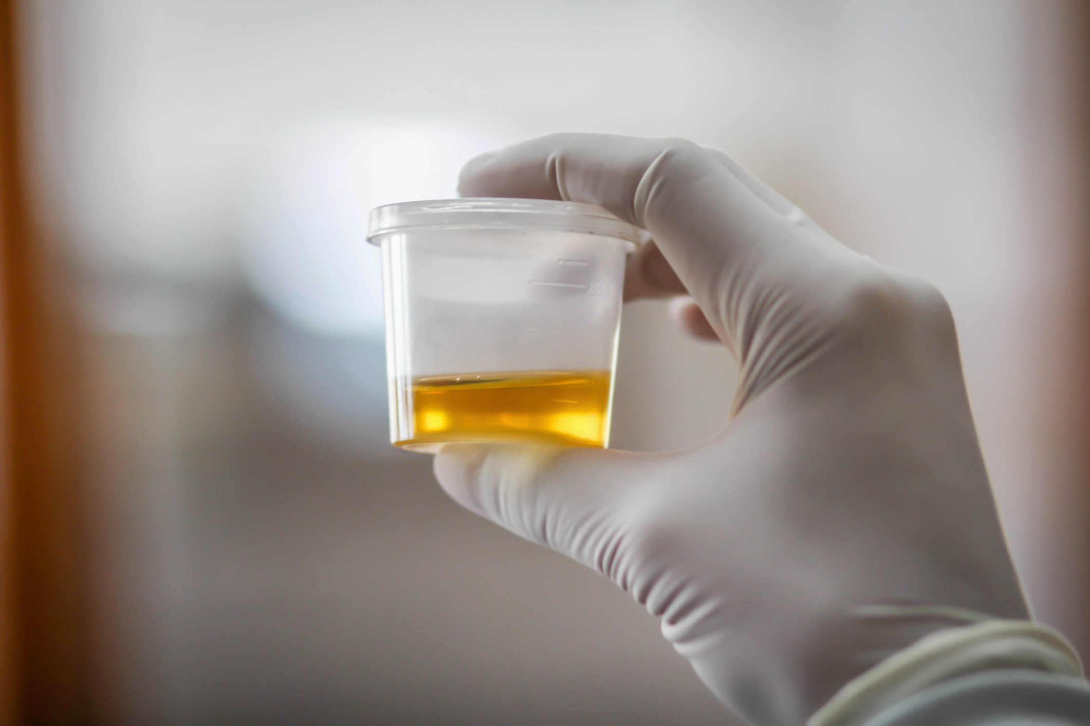 Leukocytes in urine: Causes, sym...