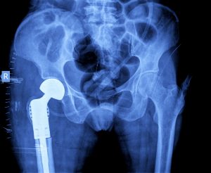 protect-your-bones-prevent-hip-replacement