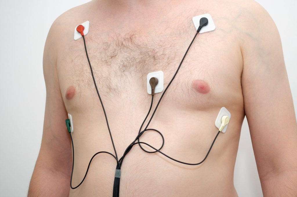 How Long Does Atrial Tachycardia Last Best Design Idea