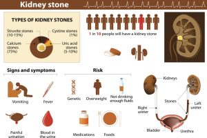 Enlarged prostate treatment may help passage of large kidney stones in the urine