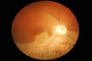 Age-related macular degeneration and macular telangiectasia caused by dysfunctional energy metabolism: Study