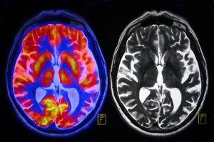 Alzheimer’s and normal brains compared, specific brain region identified for dementia prevention