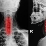 Cervical spondylosis (cervical osteoarthritis) or neck arthritis: Causes, symptoms, and treatment