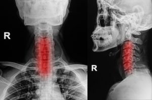Cervical spondylosis (cervical osteoarthritis) or neck arthritis