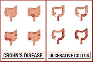 Crohn’s disease vs. ulcerative colitis