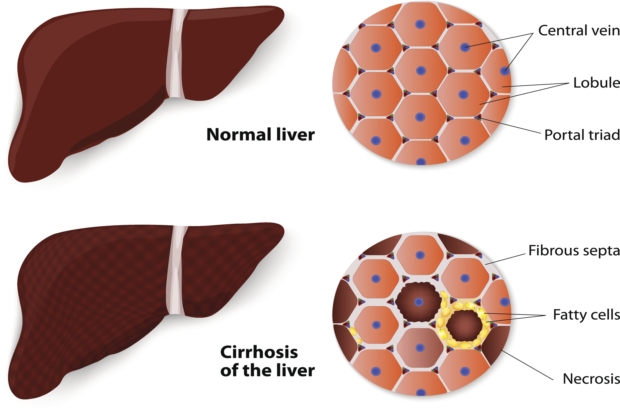 Liver fibrosis or scarring, lead...