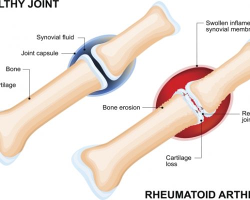 Rheumatoid arthritis, inflammatory joint disease patients at higher risk for cardiovascular disease