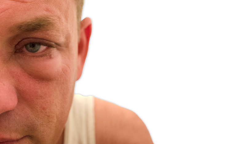 Thyroid eye disease: Causes, sym...