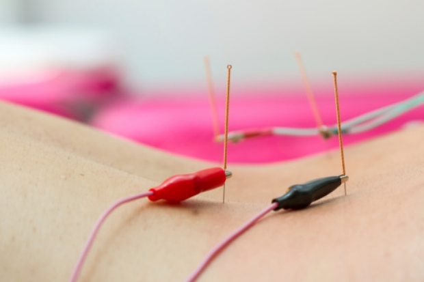 Acupuncture lowers hypertension:...