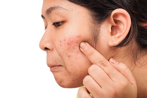 Acne can occur in women even aft...