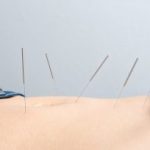 acupuncture-may-help-relieve-chronic-constipation