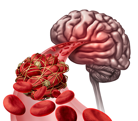 What causes blood clots in the b...