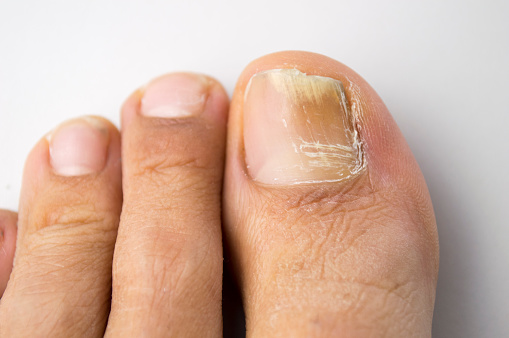 Brittle toenails: Causes and home remedies
