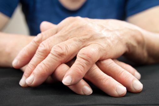 Rheumatoid arthritis patients ar...