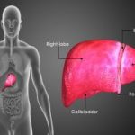 natural-home-remedies-and-diet-for-primary-biliary-cirrhosis