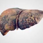 primary-biliary-cirrhosis-liver-disease