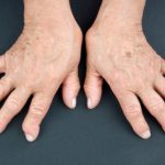 Psoriatic arthritis vs. rheumatoid arthritis: Differences in symptoms, causes, and treatments