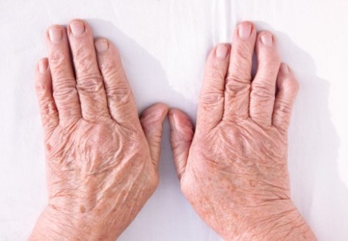 can rheumatoid arthritis cause a rash
